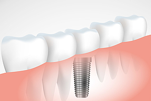Zahnimplantate: Forschungsergebnisse und ihre Konsequenzen