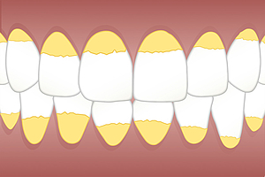 Häusliches chemisches Biofilmmanagement in der Prävention und Therapie der Gingivitis