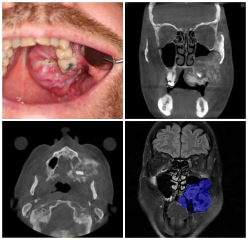 Ausgedehnter bösartiger Knochentumor im Mittelgesicht